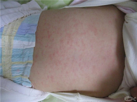 疹子的症状与治疗方法 疹子的种类