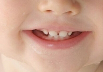 宝宝乳牙缝隙大为什么 孩子乳牙缝隙大是什么原因正常吗