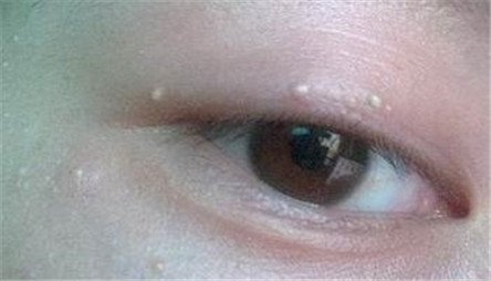眼部扁平疣的症状和治疗方法 保护好心灵的窗户