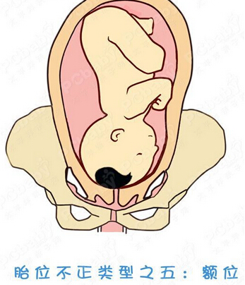 正常胎位图和胎位不正图