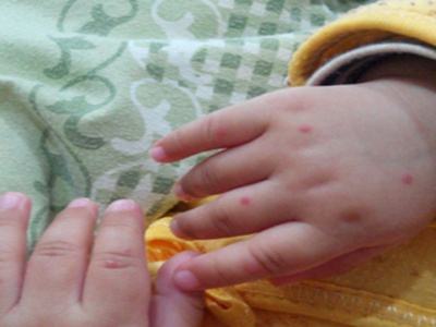 手足口病高发时期，宝妈要知道手足口病的早期症状
