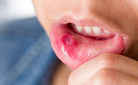 口腔溃疡怎么办 五个小方可治愈它