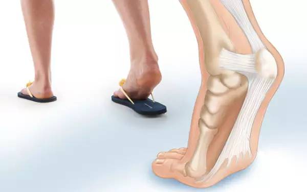 脚后跟疼是什么原因?跟痛症的发病原因