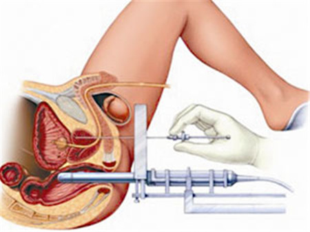 男性前列腺在什么位置图片 你对前列腺了解多少？