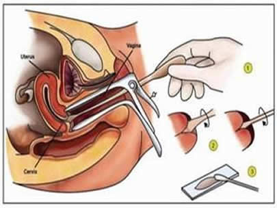 女性检查：女性阴道全套检查全过程揭晓（图）