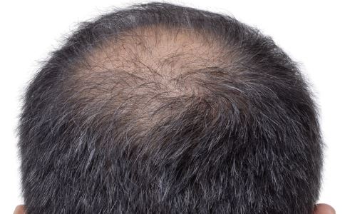 徐峥自曝20岁秃顶 造成男性秃顶的原因有哪些