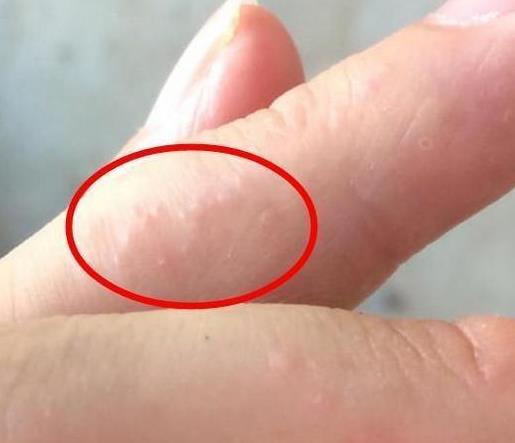 手指上起小水泡：汗疱疹千万不挠它（图）
