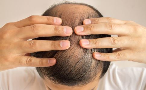 中年男人脱发的4大主因 预防比治疗更有用
