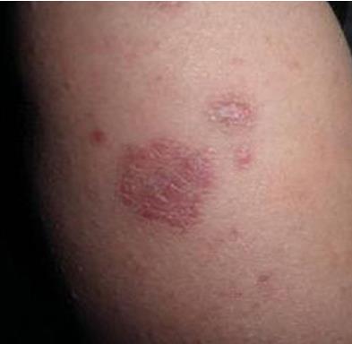 女性红斑狼疮早期症状：红斑狼疮最初症状图片