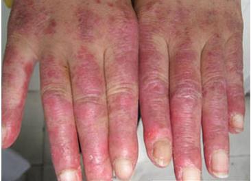 女性红斑狼疮早期症状：红斑狼疮最初症状图片