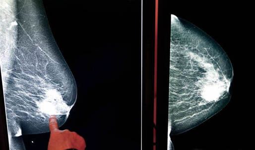 乳腺癌是怎么引起的：揭10大原因及预防（图）
