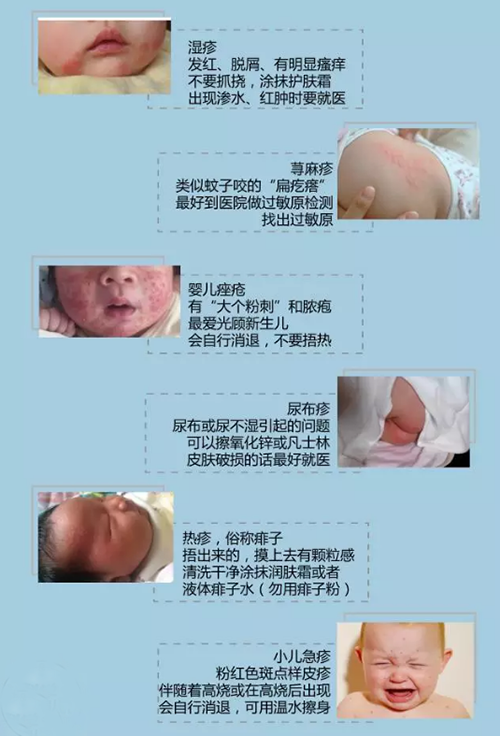 婴儿湿疹不用怕 60%的情况下用它能治好！