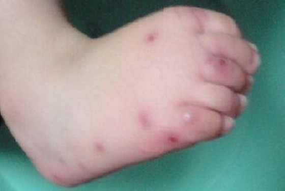 从小儿手足口病图片 看手足口病的初期症状及表现