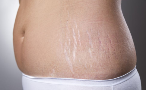 孕妇长妊娠纹怎么办?如何有效消除妊娠纹
