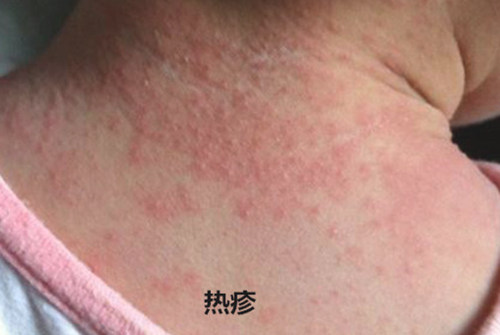 新生儿湿疹和热疹的区别在哪里 5张图片教你读懂