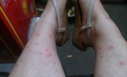 被跳蚤咬的症状图片：不小心被跳蚤咬了危害有哪些