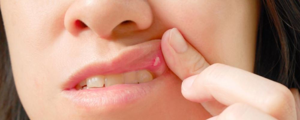 口腔溃疡怎么办？有哪些治疗的小偏方？