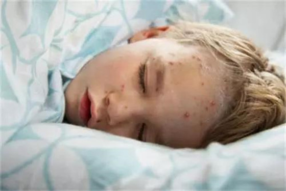 儿童水痘的症状和图片 出水痘期间饮食注意	