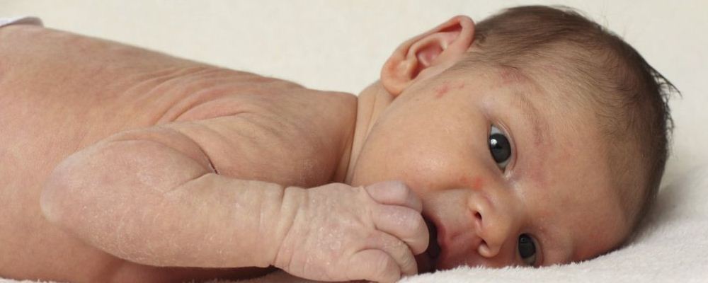 宝宝荨麻疹是什么引起的 宝宝荨麻疹的原因是什么