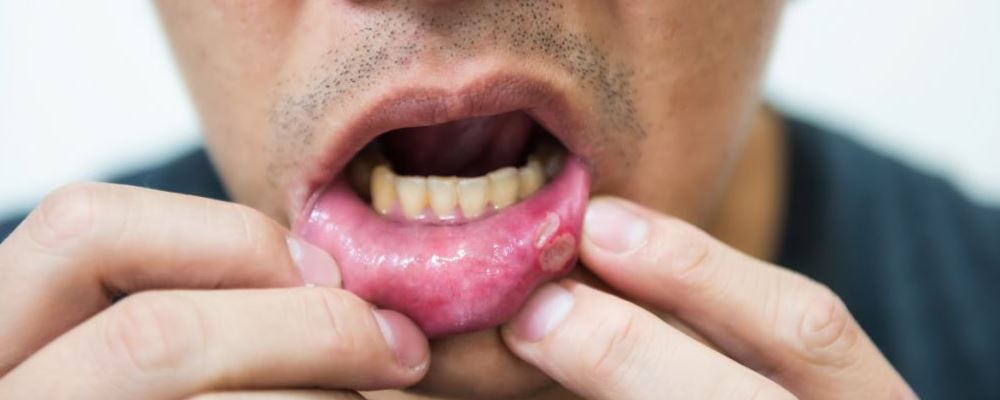 口腔溃疡反复发作是什么原因 该怎么办