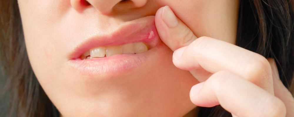 口腔溃疡反复发作是什么原因 该怎么办