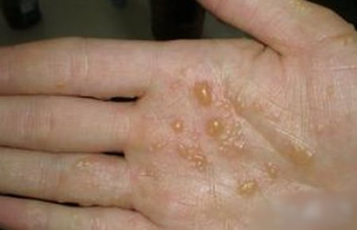 汗疱疹图片和症状图片：汗疱疹怎么引起的能自愈吗