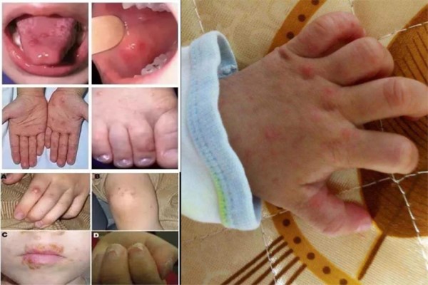 新型手足口病症状图片 新型手足口病初期症状