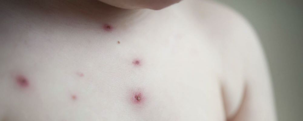 水痘是什么原因引起的 都有哪些症状