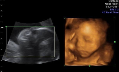 四维胎儿双侧肾盂无分离是男是女,5个月四维如何看男女?