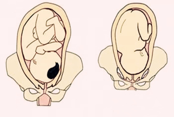 胎位头位是什么意思 胎位头位这是正常胎位吗？
