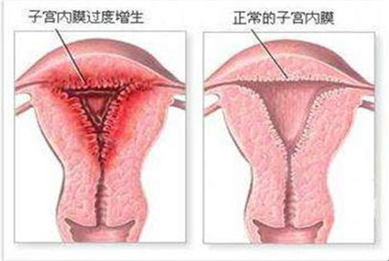 子宫内膜厚怎么回事 子宫内膜增厚如何治疗？