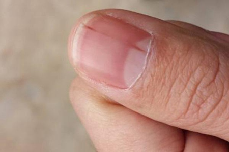 指甲上有竖纹的产生原因，这一种大病征兆要小心预防