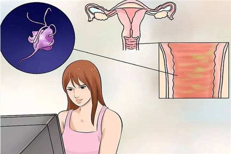 阴道炎反复发作的四个原因