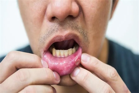 口腔溃疡发病原因,口腔溃疡的治疗方法这样做100%有效