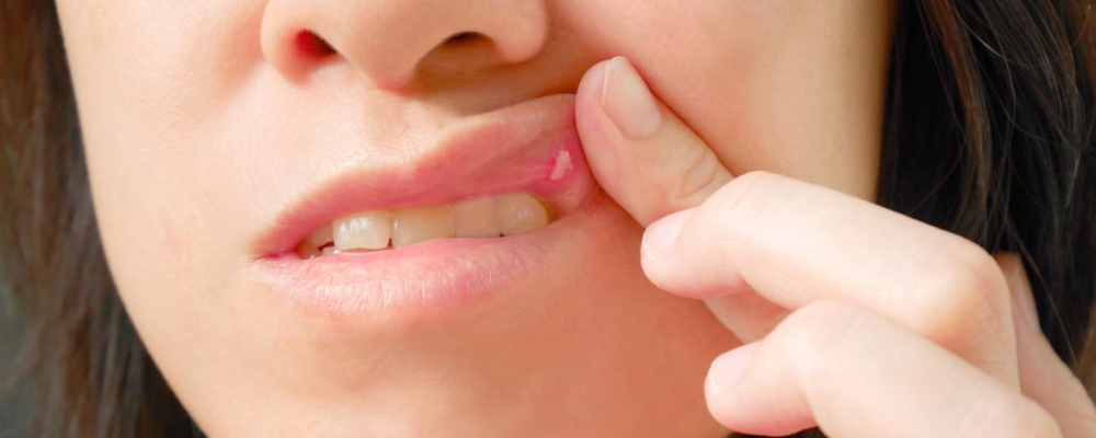口腔溃疡怎么治疗 下面这些妙招分享给你