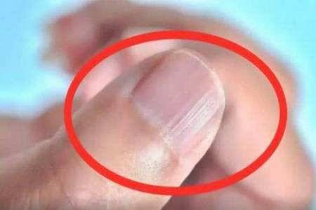 指甲上有竖纹是怎么回事?除了这五点也预示着某些疾病