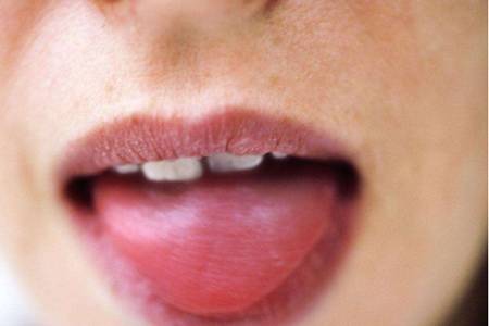 舌苔厚白的原因,除了上火还有可能是这种疾病