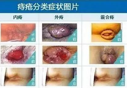 女性痔疮真人实拍图片：网上曝光的7个小偏方有效治痔疮