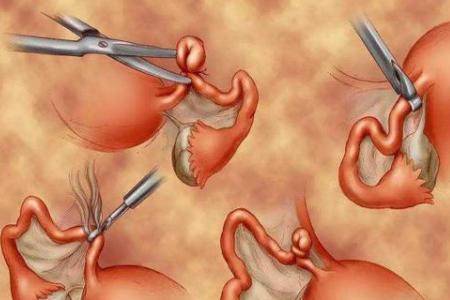 二胎剖腹产后做结扎手术 结扎对女性身体影响有多大
