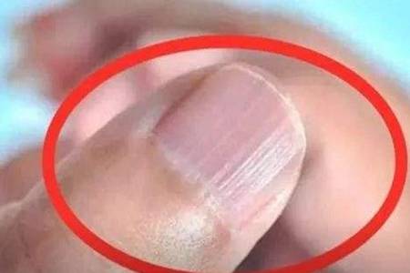 指甲上有竖纹是怎么回事 什么原因引起指甲竖纹