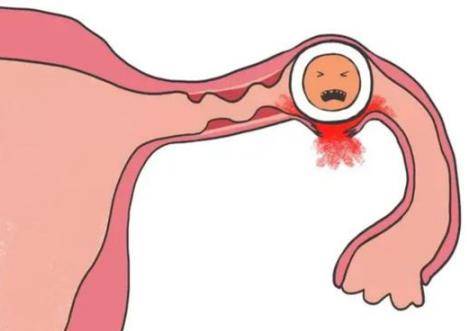 孕前认识宫外孕是什么 详讲造成宫外孕的三种原因