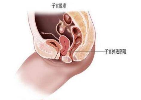产后如何防止子宫下垂 子宫收缩恢复的五个有效方法