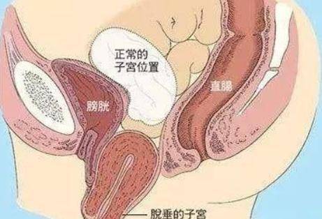 产后如何防止子宫下垂 子宫收缩恢复的五个有效方法