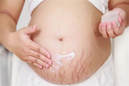 老公嫌弃肚子妊娠纹怎么办 妊娠纹的预防和祛除手段