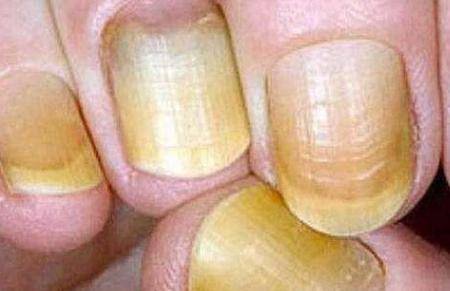 肝受损时指甲会有一些表现 指甲上有竖纹是怎么回事？