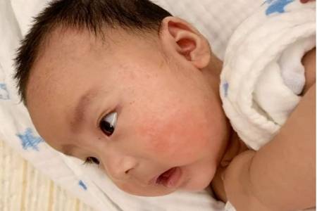 婴儿湿疹最佳治疗方法 五个方法解决宝宝红肿湿疹
