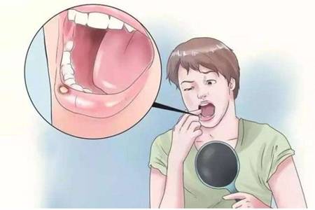 口腔溃疡发病六大原因,小妙招让你远离溃疡疼痛