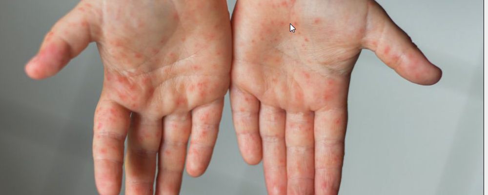 手足口病传染系数是新冠病毒3倍 手足口病的传播途径
