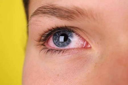 眼睛红血丝是怎么回事,眼睛疲劳发红的五大原因要重视