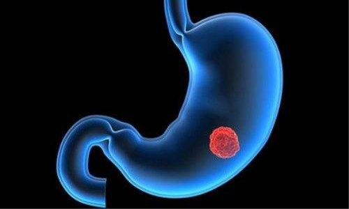 胃溃疡症状表现有哪些？胃溃疡的治疗和用药